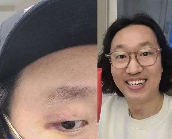 잘 아문 김경진의 상처 부위 / 스포츠 투데이 